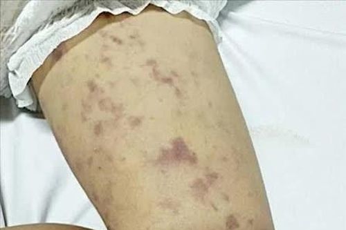 Phát hiện chùm ca bệnh não mô cầu tại TP Hồ Chí Minh, một học sinh tử vong​