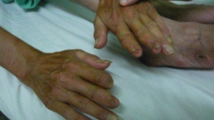 Các đầu ngón tay bị cụt do tác hại của thuốc lá của anh Đ - Ảnh: Thanh Huyền