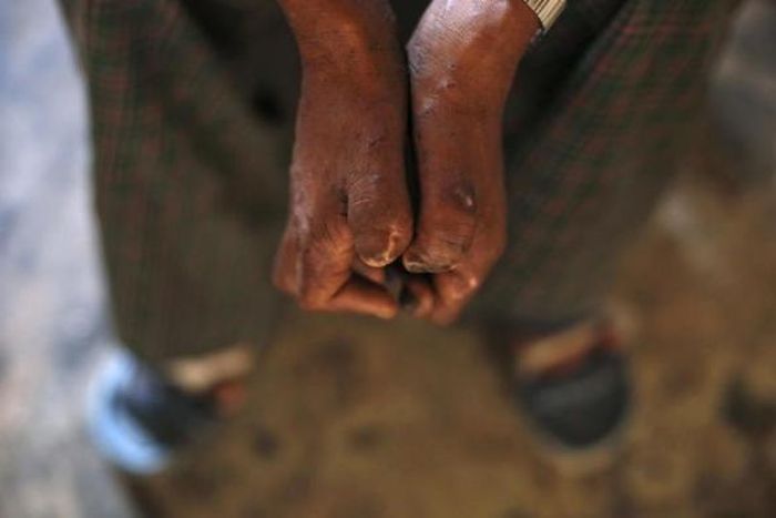  Đôi bàn tay với các ngón tay bị co quắp của một bệnh nhân mắc bệnh phong ở Myanmar. Trên thực tế, bệnh phong rất khó lây, không di truyền và có khả năng chữa khỏi. Theo ước tính của chính phủ, kể từ năm 1991 đến nay, đã có khoảng 300.000 bệnh nhân phong được chữa khỏi bệnh.
