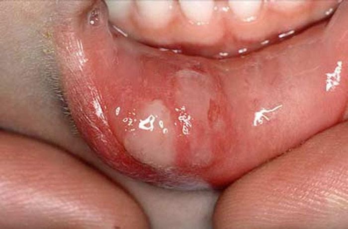  Củng cố về tác hại của thuốc lá nhai, dược sĩ Irina Stepanov đến từ Bệnh viện Ung thư Đại học Minnesota Masonic (Mỹ) cho rằng nó cũng nguy hại không kém việc hút thuốc lá. Cụ thể, một liều thuốc lá nhai có lượng polyciclic aromatic hydrocarbon (PAH) tương đương 5 điếu thuốc lá. Trong khi đó, PAH chỉ là một trong số 28 chất gây ung thư bị phát hiện trong loại thuốc lá này. Nó là nguyên nhân chính gây ung thư miệng cho những thanh niên người Ấn Độ.