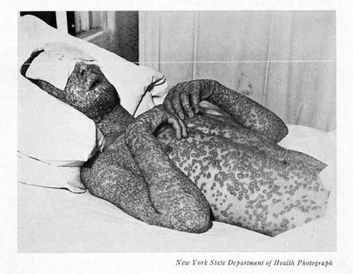 Căn bệnh này còn đáng sợ đến mức có thể lan truyền qua việc hít phải các virus có trong không khí, thường từ các dịch từ vùng họng, mũi, niêm mạc họng của người nhiễm bệnh. Các chuyên gia đã điều chế được vắc xin phòng bệnh đậu mùa từ năm 1796 nhưng cho đến nay dịch bệnh này vẫn thỉnh thoảng bùng phát trở lại.