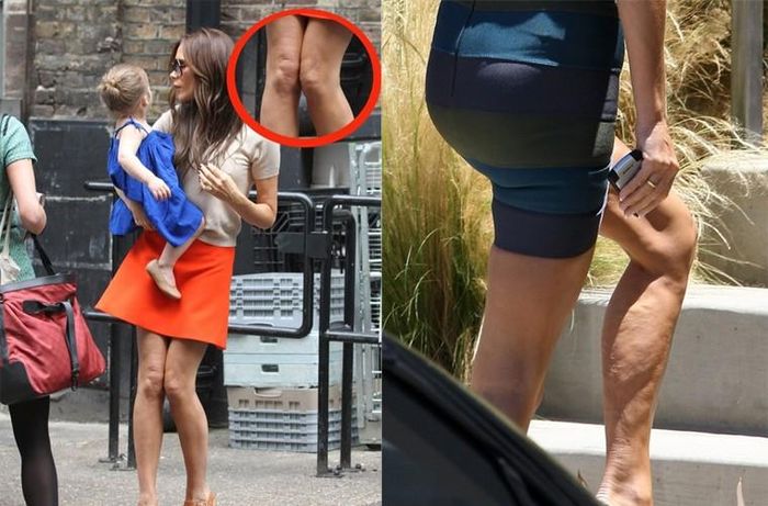 Làn da của Victoria Beckham vốn không đẹp nên đôi chân cô nhăn nhúm chỗ lồi chỗ lõm cũng là điều dễ hiểu. 