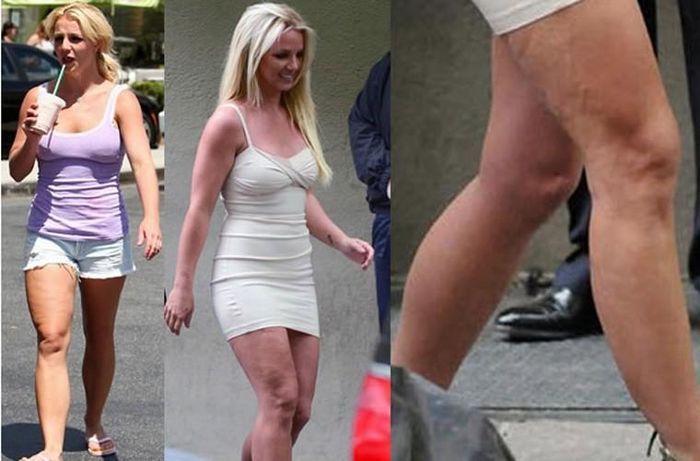 Thân hình của Britney Spears đã tàn tạ sau hai lần sinh nở và lối sống hoang dại một thời và hậu quả là đôi chân lồi lõm xấu xí.