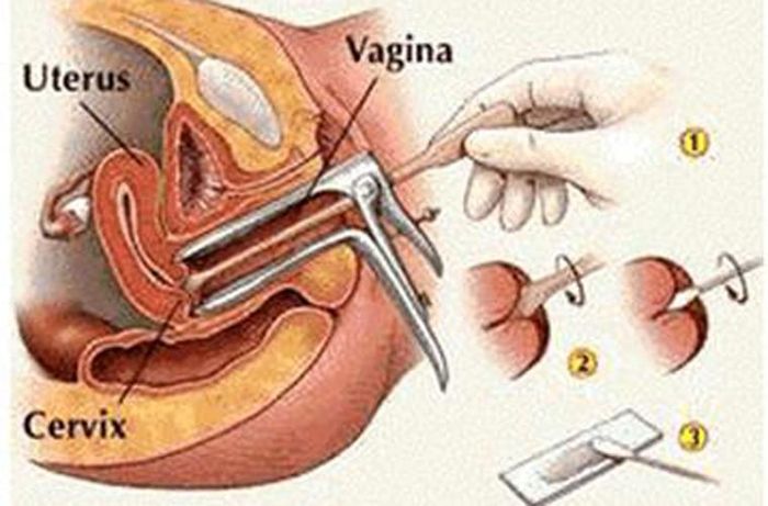  Khi thực hiện xét nghiệm Pap, bác sĩ sẽ dùng một dụng cụ chuyên khoa cào nhẹ một lượng tế bào ở cổ tử cung và âm đạo. Những tế bào này được dùng để kiểm tra dưới kính hiển vi; tìm hiểu xem có sự bất thường nào không.