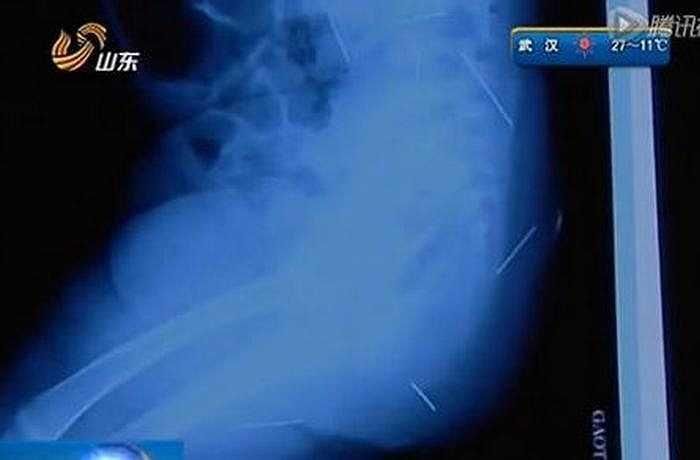 Các bác sĩ đã lấy ra 3 chiếc kim trong bụng và em bé đang được tiếp tục theo dõi.