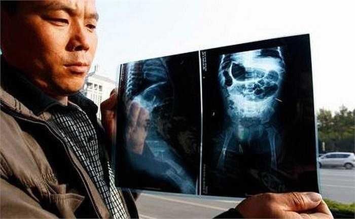 Bố mẹ của Zhang cho biết, họ đã đưa con gái đến bệnh viện Qilu thuộc Đại học Sơn Đông sau khi cô bé cảm thấy khó chịu mỗi khi ai động vào người bé.