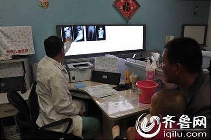Vẫn còn 9 chiếc kim trong cơ thể bé.