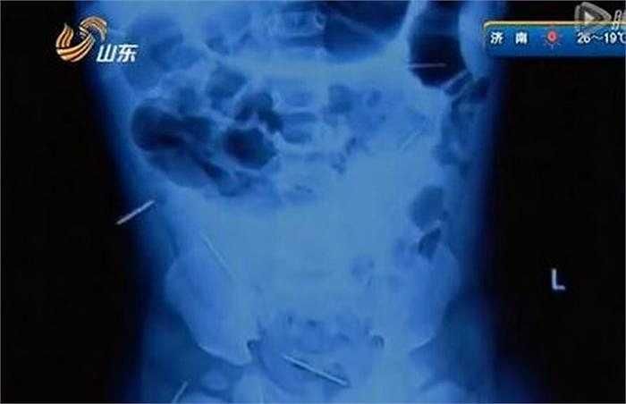 Hình ảnh chụp X-quang cho thấy, 12 chiếc kim xuất hiện ở phần hông, bụng và xương chậu của cô bé.