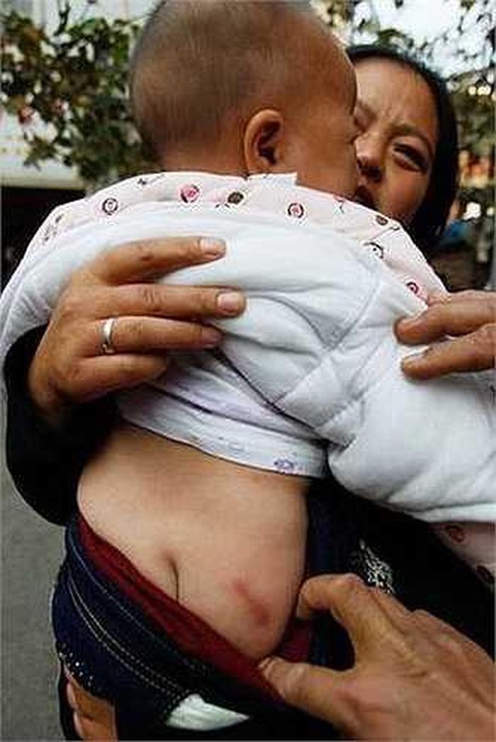 Mẹ bé đã phát hiện những vết đỏ ở phần mông của cô bé.
