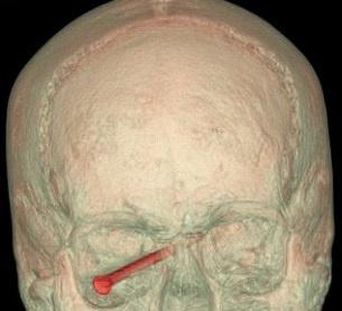  Chiếc đinh 9cm may mắn không xuyên thủng nhãn cầu. 