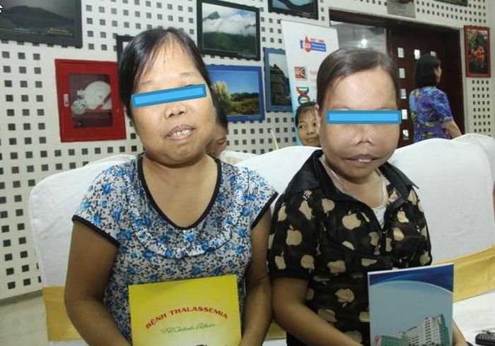 Chị Phạm Thị Vân (bên phải) hơn 24 tuổi nhưng nhìn chị thấp, bé như đứa trẻ lớp 1