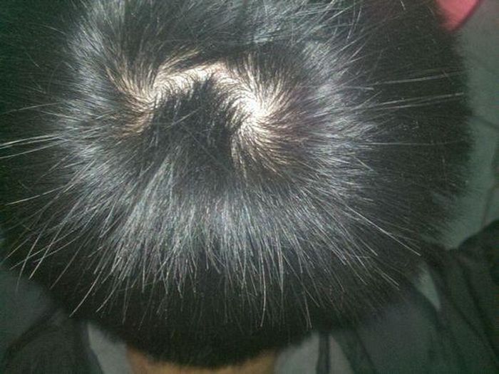 Người có hai xoáy đầu: Là người vô cùng thông minh, hoạt bát và cởi mở. Khi còn nhỏ thì hiếu động, nghịch ngợm, thường ngang bướng không chịu nghe lời, cha mẹ thường khó giáo dưỡng. Tính cách bộc trực ngay thẳng, có tư tưởng lớn, có chí tiến thủ, luôn tiến lên chứ không bao giờ chịu lùi bước, có khả năng lãnh đạo. Vì thế, họ thường có thể làm nên sự nghiệp