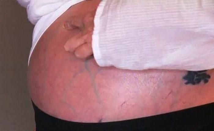 Chữa xơ gan cổ trướng. Dùng bồ hóng bếp đã giã nhỏ, rây mịn và men rượu (tỷ lệ 3:1), thêm vào một ít mủ xương rồng để có hỗn hợp nhão vắt thành viên có kích thước bằng hạt ngô. Ngày dùng 3 viên cho vào chuối chín rồi nuốt. Khi đi ngoài thấy phân trắng như nước gạo là khỏi. Ảnh: Benhvienthucuc.