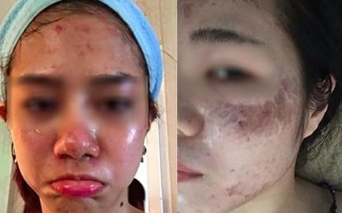 Một nạn nhân của phương pháp lăn kim làm đẹp da. Ảnh: Internet