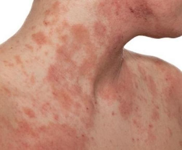 Điều trị bệnh ngoài da. Dùng 1g bột gỗ sưa, 3g hùng hoàng, 1g axit salicylic, 10ml nước diếp cá, thất lý tán (hỗn hợp gồm trân châu, tổ yến, hoàng liên, khổ hạnh nhân, bán hạ, mạch nha, phục linh, trần bì, thần khúc, cam thảo, hổ phách...) trộn đều bôi lên chỗ da bị chàm mỗi ngày một lần. Ảnh: Benhviemda.