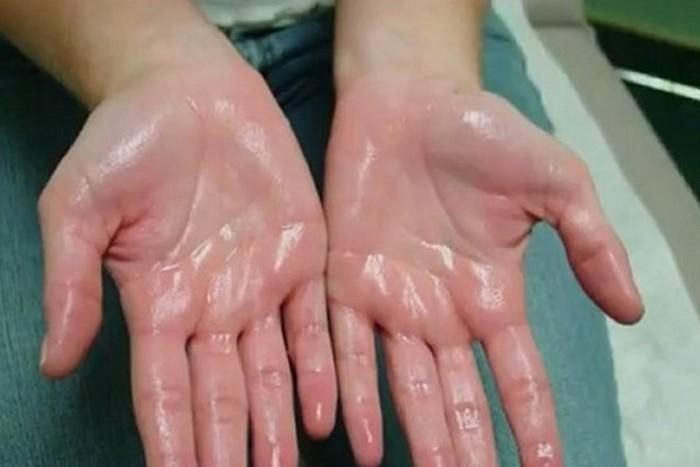 Trị chứng ra mồ hôi trộm do dương hư. Dùng vỏ hàu, rễ ma hoàng, nhân sâm, bạch truật, bán hạ, ngũ vị tử, mỗi vị 30g. Bá tử nhân 60g, tiểu mạch 15g. Làm viên hoàn, mỗi lần uống 10g. Uống liền 2 - 3 tuần tới khi hết triệu chứng, có thể uống vài liệu trình. Ảnh: tamsugiadinh.