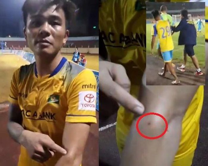 Cánh tay của Mạnh Hùng bị “trọng thương” sau pha cắn trộm của cầu thủ Zarour Chaher. Ảnh: Quỳnh Trang.