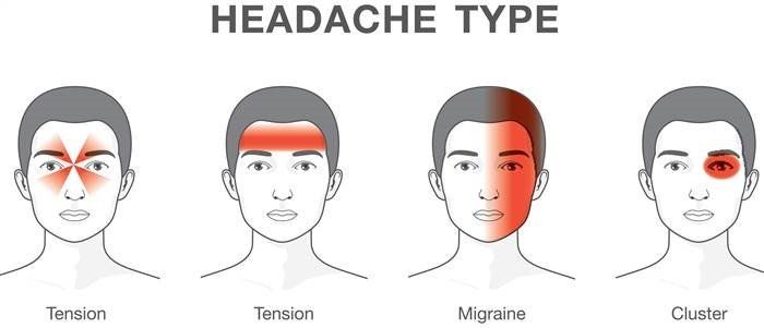  VÙng đau nói lên chứng đau đầu của bạn thuộc loại nào
