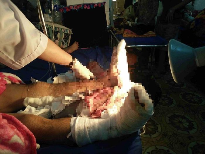 Nạn nhân bị chém đứt chân