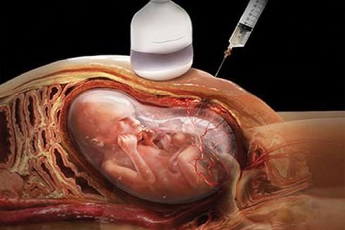Chọc hút nước ối giúp phát hiện dị tật bẩm sinh