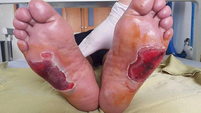  Một ca bỏng nặng ở lòng bàn chân do chườm đá nóng để chữa tê bì