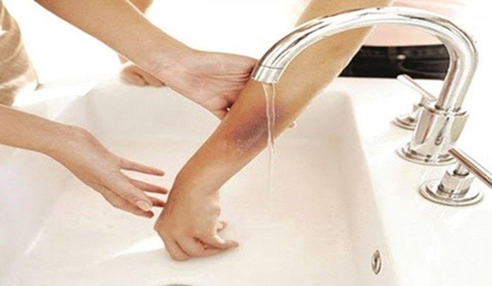  Sơ cứu người bị bỏng axit rất quan trọng. (Ảnh: Zing) 