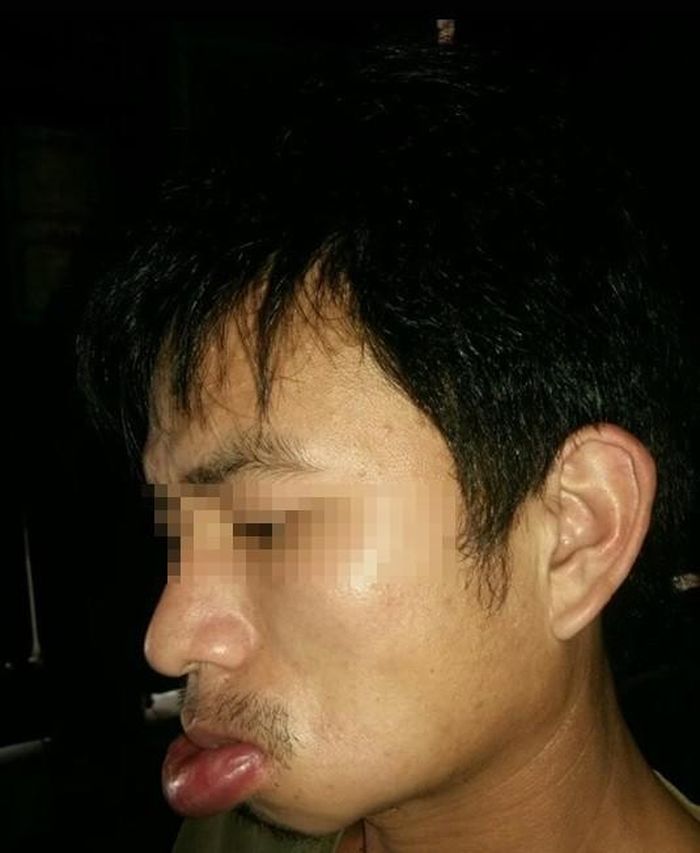 Khuôn mặt của anh Lực bị biến dạng do bệnh viêm mao mạch dị ứng