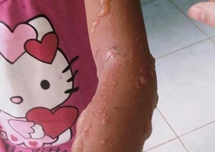 Đến nay, một số trung tâm y tế các xã, huyện ở Tây Nguyên đã ghi nhận nhiều trường hợp nhập viện vì bỏng ngứa, nóng sốt nghi do chất độc từ loài bọ 3 sọc này. Ảnh: Dân Việt.
