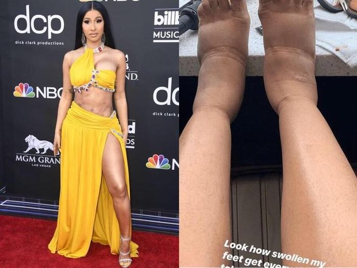 Hình ảnh đôi chân phù nề được Cardi B chia sẻ trên trang cá nhân hồi tháng 5. 
