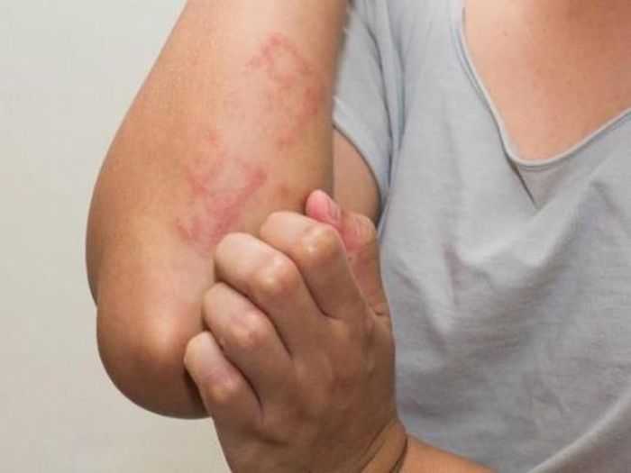 Khi đến một môi trường lạ, chúng ta (nhất là những người có cơ địa nhạy cảm) rất dễ gặp các tình trạng dị ứng như: dị ứng thức ăn, dị ứng thời tiết, dị ứng côn trùng… Ngay sau khi tiếp xúc với tác nhân gây dị ứng, trên da có thể xuất hiện những cục, mảng gồ lên trên da và rất ngứa. Mảng này có thể biến mất trong vòng vài giờ đồng hồ nhưng cũng có thể xuất hiện ở một nơi khác trong cơ thể... Nặng hơn, có thể gặp hiện tượng phù môi, sưng mắt, thậm chí sốc phản vệ… Ảnh minh họa: Internet