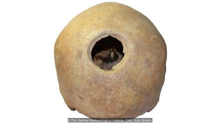 Hộp sọ của một phụ nữ khoảng 20-25 tuổi. Lỗ hổng có dấu hiệu chữa lành một phần. Ảnh: Viện Khảo cổ Đức (DAI).