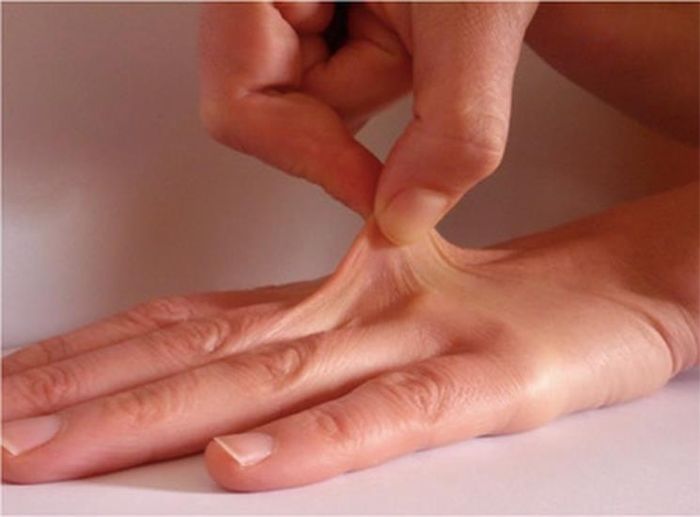 Những người mắc hội chứng Ehlers-Danlos thường có làn da căng giãn, mỏng manh. Ảnh: Avas.