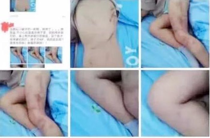 Vết thương chằng chịt khắp cơ thể bé trai 4 tuổi