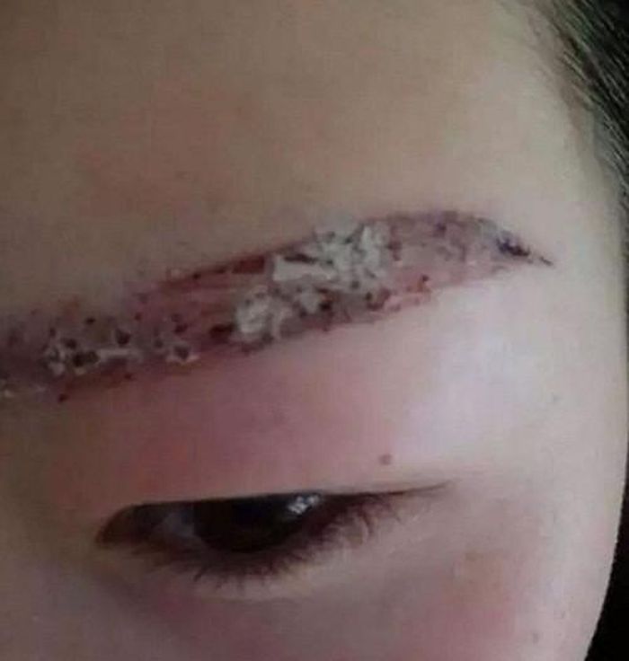 Một cô gái Trung Quốc đã chia sẻ hình ảnh lông mày bị bong tróc sau khi xăm, thậm chí còn chẳng sót lại sợi nào.