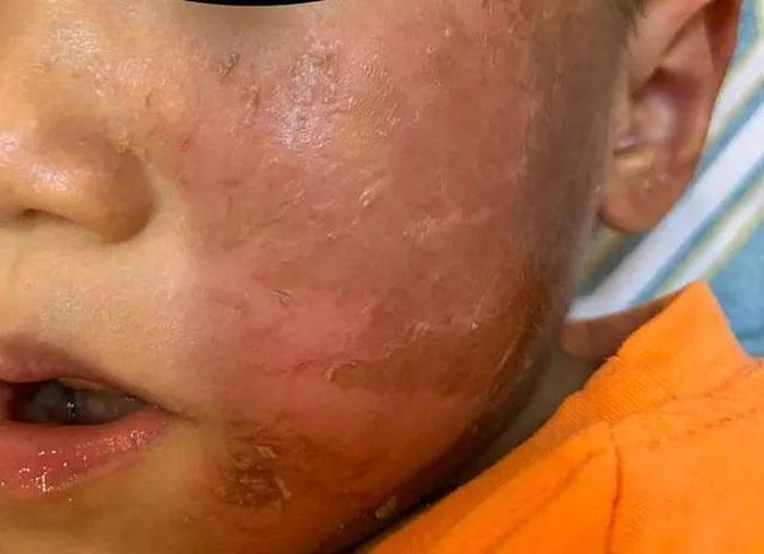 Bệnh nhi bị viêm da dị ứng do đeo mặt nạ hóa trang (ảnh: báo Tổ quốc)