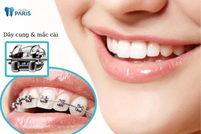 Niềng răng mắc cài kim loại tự buộc