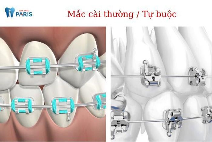 Sự khác nhau của hai loại niềng răng mắc cài kim loại