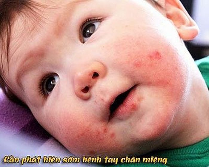 Sớm phát hiện bênh chân tay miệng để kịp điều trị