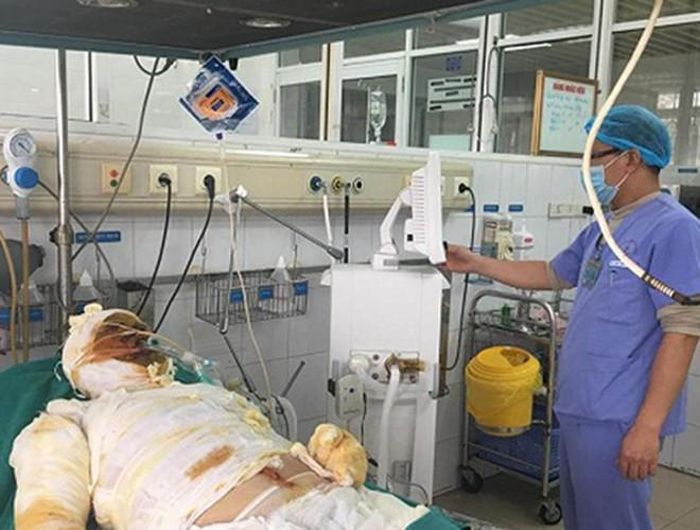  Theo chia sẻ của bác sĩ Nguyễn Hải An, Trường khoa Hồi sức Cấp cứu, Viện Bỏng Quốc gia, vết bỏng trên tay bệnh nhân nhân Nguyễn Văn D., ở Bắc Giang quá sâu, điều trị không tiến triển nên cuối cùng vẫn phải cắt cụt 2/3 cánh tay (nguồn: Vietnamnet) 