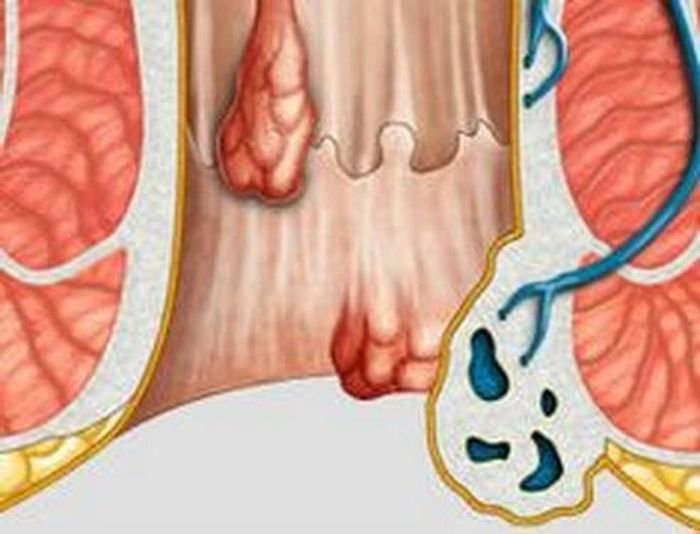 Trĩ gây đau đớn, ảnh hưởng tới cuộc sống hằng ngày của người bệnh.
