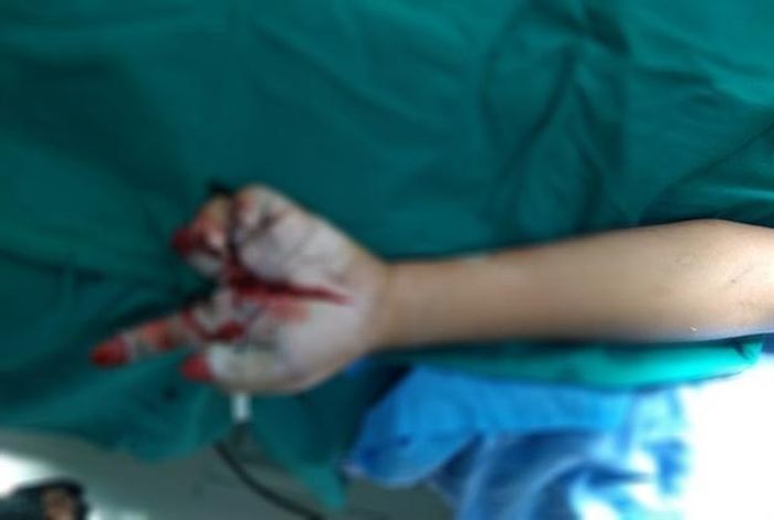 Nghịch pháo nổ nhiều ngón tay bị cụt