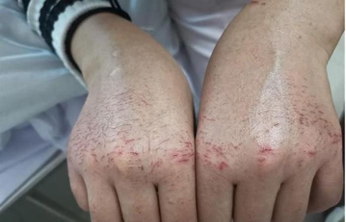  Qua một thời gian bó chặt bàn tay trong găng tay y tế, khử trùng bằng dung dịch nhiều cồn và nước để đảm bảo đôi tay luôn sạch khuẩn, làn da của các nhân viên y tế bắt đầu xuất hiện dấu hiệu thương tổn. Giờ đây, đôi tay trở nên chằng chịt vết nứt đỏ tấy, hằn lên tơ máu.