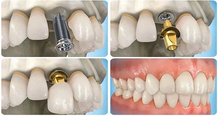 Quá trình trồng răng Implant (ảnh minh họa)