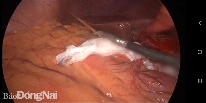 Tăm tre nằm trong dạ dày (ảnh chụp từ thiết bị nội soi)