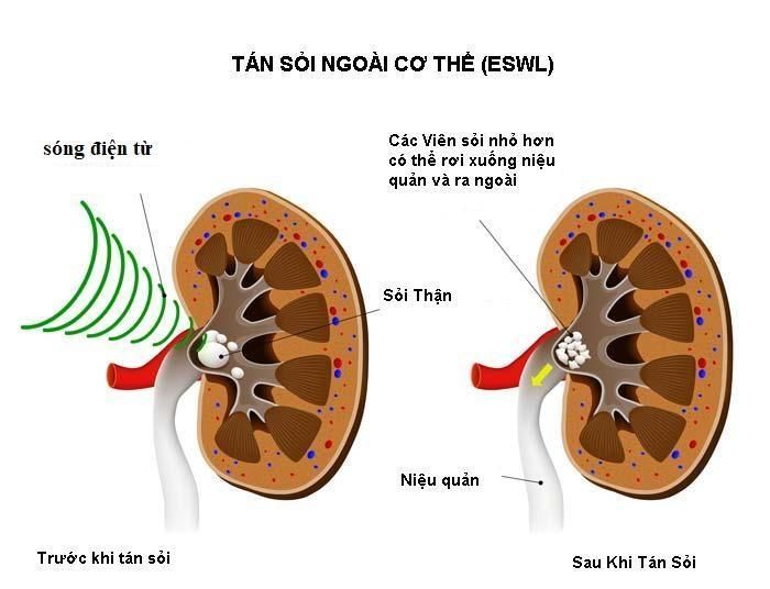 Công nghệ hiện đại giúp người bị sỏi thận, sỏi tiết niệu có thể sạch sỏi không phẫu thuật, không đau, không nằm viện. (ảnh minh họa)