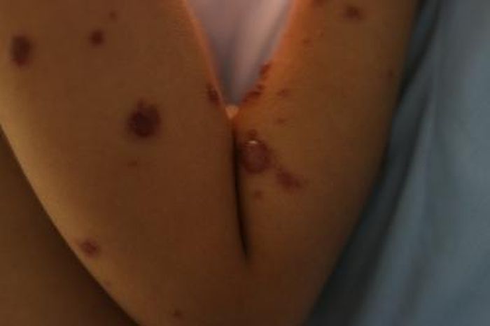Các nốt phồng trên da bé