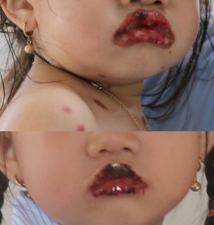 Môi của bé giảm lở loét và bình phục dần sau điều trị