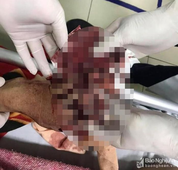 Vụ nổ làm nạn nhân bị nát bàn tay. Ảnh: Ngọc Sơn