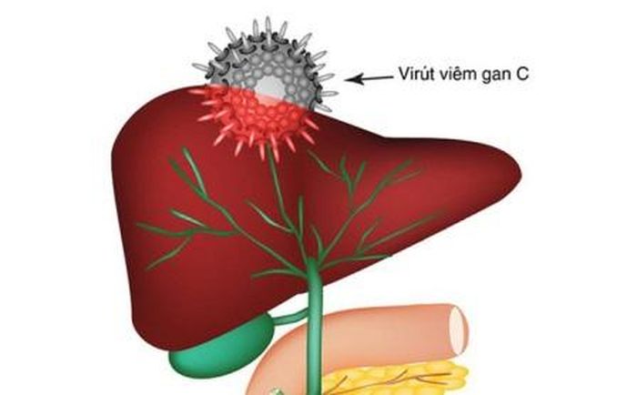 Viêm gan C có thể dẫn đến xơ gan, ung thư gan