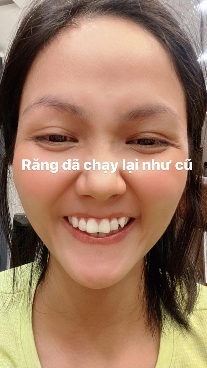 Hàm răng của H'Hen Niê lúc thi Miss Universe 2018 (trái) và hiện tại. 